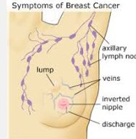 A picture of the potential changes to look for when doing your breast self-exam
