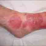 One form of Cellulitis