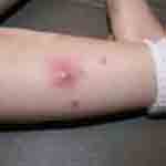 An example of how Cellutlitis starts