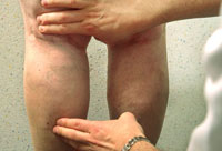 A woman with swollen legs