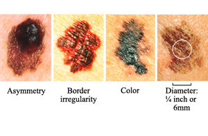 Different types of dangerous moles